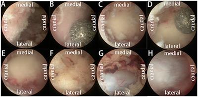 Unilateral biportal endoscopy vs. open decompression for lumbar epidural lipomatosis-cohort study using a prospective registry